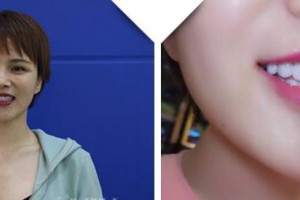 南充遠大口腔門診部王云玲整形價格表附牙貼面案例展示