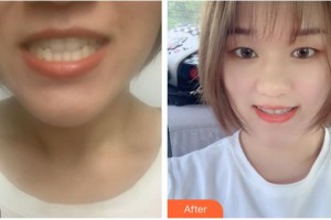 南充德美牙科診所歐陽霞整形價格表附金屬托槽矯正案例展示