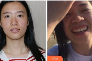 南充美佳口腔診所蘇懷風整形價格表附牙齒隱形矯正案例展示