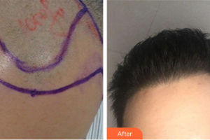 深圳麗格云發(fā)醫(yī)療美容診所石金鷺整形價格表附植發(fā)案例展示