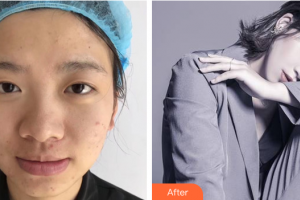 深圳陽光整形美容醫(yī)院樸在久整形價格表附眼部手術(shù)案例展示