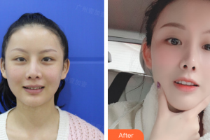 深圳羅湖區(qū)同步口腔門診部胡偉濤整形價格表附美白瓷貼面案例展示