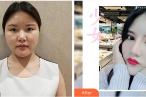 眉山華信醫(yī)學整形美容醫(yī)院李健剛整形價格表附切開雙眼皮案例展示