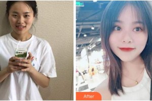 眉山華信醫(yī)學整形美容醫(yī)院金碩正整形價格表附開內(nèi)眼角案例展示