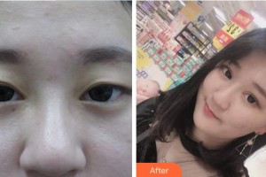 眉山市人民醫(yī)院醫(yī)學美容科張玉瓊整形價格表附定點雙眼皮案例展示
