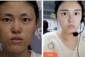 眉山市人民醫(yī)院醫(yī)學美容科陳輝整形價格表附切開雙眼皮案例展示