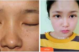 眉山天使醫(yī)療美容整形醫(yī)院倪俊整形價格表附切開雙眼皮案例展示