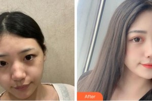 眉山天使醫(yī)療美容整形醫(yī)院鄭靜整形價格表附激光祛斑案例展示