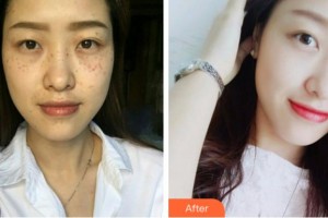 眉山皮膚病醫(yī)院皮膚美容科鄭雪蕾整形價格表附鐳射凈膚案例展示