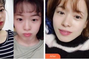 眉山仁壽星辰醫(yī)療美容門診部李亮整形價格表附眼部綜合案例展示