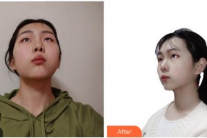 眉山悅美醫(yī)療美容門診部衡敏整形價格表附光子嫩膚案例展示