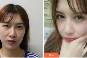 眉山眼耳鼻咽喉?？漆t(yī)院龔恩進整形價格表附切開雙眼皮案例展示