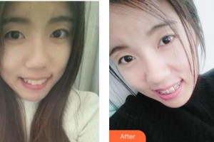 宜賓市第一人民醫(yī)院整形燒傷科杜永貴整形價(jià)格表附金屬托槽矯正案例展示