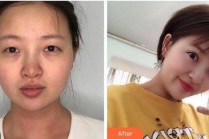 宜賓愛(ài)爾優(yōu)視眼科醫(yī)院楊敏整形價(jià)格表附眼部綜合案例展示