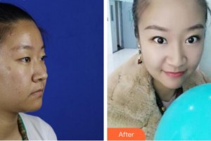 宜賓愛(ài)爾優(yōu)視眼科醫(yī)院徐文烽整形價(jià)格表附眼部綜合案例展示