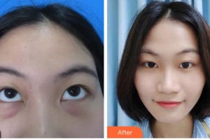 宜賓愛(ài)爾優(yōu)視眼科醫(yī)院宋玉偉整形價(jià)格表附激光去眼袋案例展示