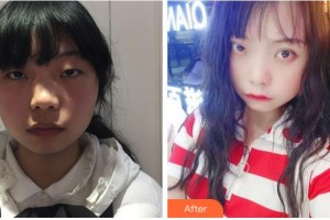 宜賓愛(ài)爾優(yōu)視眼科醫(yī)院王朝瑜整形價(jià)格表附切開(kāi)雙眼皮案例展示