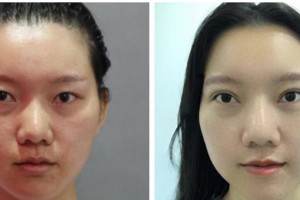 宜賓愛(ài)爾優(yōu)視眼科醫(yī)院劉秀麗整形價(jià)格表附眼部綜合案例展示