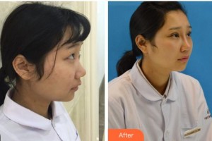 宜賓愛(ài)爾優(yōu)視眼科醫(yī)院孫安勝整形價(jià)格表附切開(kāi)雙眼皮案例展示