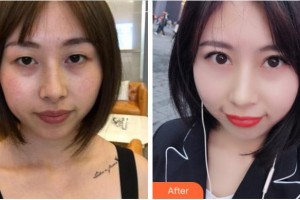 宜賓愛(ài)爾優(yōu)視眼科醫(yī)院陳龍華整形價(jià)格表附切開(kāi)雙眼皮案例展示