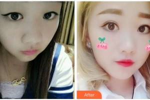 宜賓愛(ài)爾優(yōu)視眼科醫(yī)院整形價(jià)格表附眼部修復(fù)案例展示