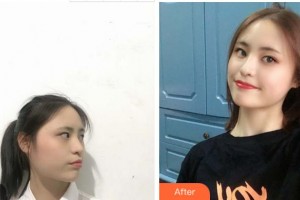 宜賓曼薇醫(yī)學(xué)整形醫(yī)院鄒勇整形價(jià)格表附切開(kāi)雙眼皮案例展示