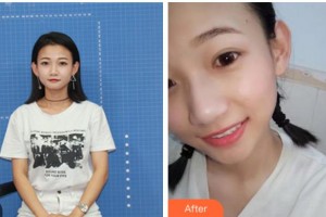 宜賓口腔醫(yī)院佘曉晴整形價格表附牙齒隱形矯正案例展示