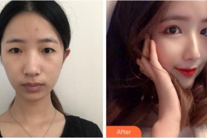 宜賓天使之翼醫(yī)療美容整形門診部尤軍整形價格表附眼部綜合案例展示