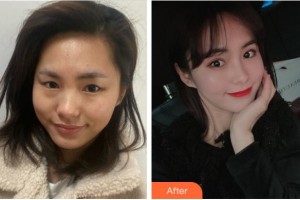 廣安市人民醫(yī)院燒傷整形美容科李凡整形價格表附眼部綜合案例展示