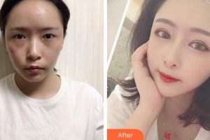 廣安阿藍(lán)醫(yī)院醫(yī)療美容科蘭洪明整形價格表附眼部綜合案例展示