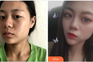 廣安阿藍(lán)醫(yī)院醫(yī)療美容科王靜整形價格表附眼部綜合案例展示