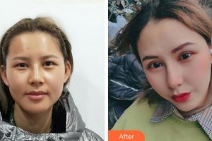 達(dá)州愛爾博視醫(yī)院胡建斌整形價格表附上瞼提肌案例展示