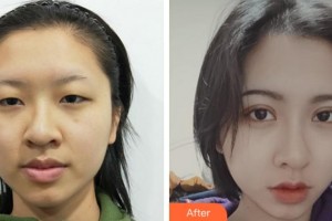 達(dá)州愛爾博視醫(yī)院蔣幼芹整形價格表附開內(nèi)眼角案例展示