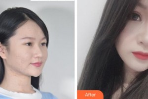 達(dá)州愛爾博視醫(yī)院王錚整形價格表附眼部綜合案例展示