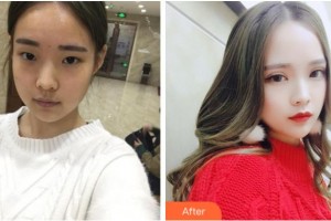 達(dá)州市中西醫(yī)結(jié)合醫(yī)院眼科甘國菊整形價格表附切開雙眼皮案例展示