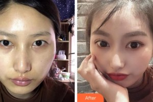 達(dá)州市中西醫(yī)結(jié)合醫(yī)院眼科王斌整形價(jià)格表附切開雙眼皮案例展示