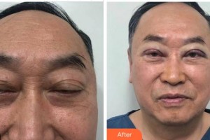 雅安鑫西華口腔整形醫(yī)院李佩紜整形價(jià)格表附切開雙眼皮案例展示