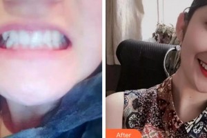 雅安鑫西華口腔整形醫(yī)院李毅整形價(jià)格表附牙齒陶瓷矯正案例展示