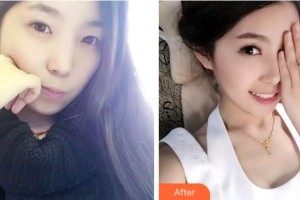 雅安鑫西華口腔整形醫(yī)院周穎整形價(jià)格表附牙齒隱形矯正案例展示