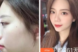 雅安鑫西華口腔整形醫(yī)院劉國(guó)敏整形價(jià)格表附金屬托槽矯正案例展示