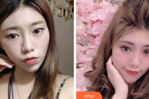 巴中依韓（原雙均）醫(yī)療美容診所張永茂整形價(jià)格表附眼部綜合案例展示