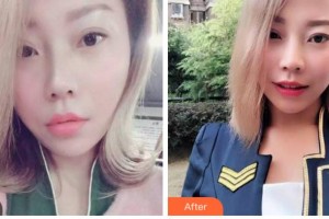 巴中華醫(yī)口腔醫(yī)院母汶靈整形價(jià)格表附牙齒隱形矯正案例展示