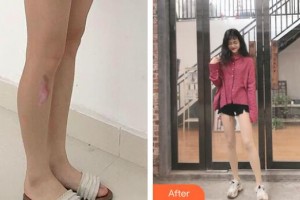 資陽(yáng)市第一人民醫(yī)院燒傷整形科伍建華整形價(jià)格表附激光祛疤案例展示