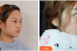 資陽(yáng)麗人醫(yī)療美容門診部肖麗整形價(jià)格表附鼻部綜合案例展示