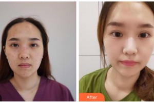 資陽(yáng)麗人醫(yī)療美容門診部柯春整形價(jià)格表附激光點(diǎn)痣案例展示