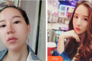 資陽(yáng)伊之美整形美容醫(yī)院張梅整形價(jià)格表附鼻部綜合案例展示