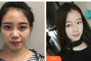 資陽(yáng)伊之美整形美容醫(yī)院李正勇整形價(jià)格表附鼻部綜合案例展示