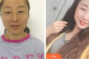 資陽(yáng)市中醫(yī)醫(yī)院眼科楊建芳整形價(jià)格表附內(nèi)切祛眼袋案例展示