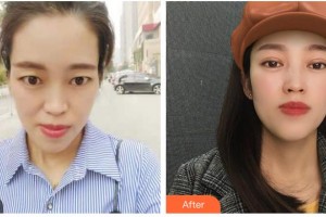 資陽(yáng)維多利亞醫(yī)療美容醫(yī)院黃國(guó)強(qiáng)整形價(jià)格表附切開雙眼皮案例展示