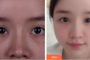 資陽(yáng)市中醫(yī)醫(yī)院眼科王耀住院醫(yī)師整形價(jià)格表附眼部修復(fù)案例展示